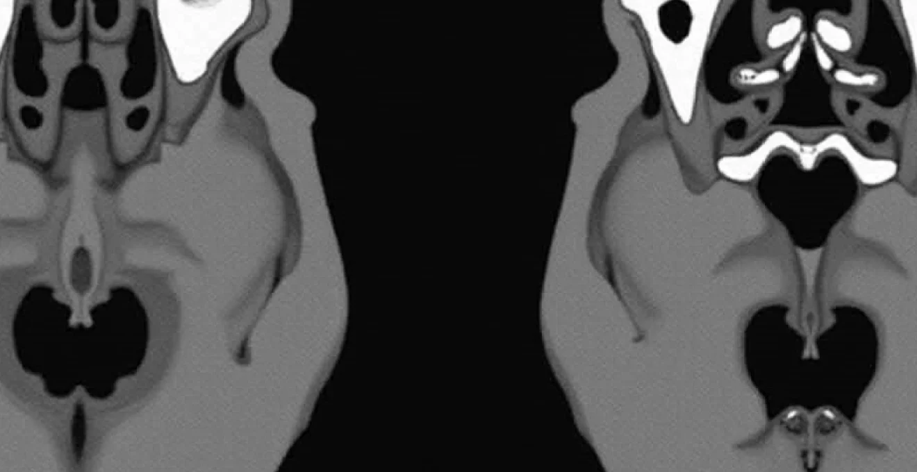 understanding-disc-osteophyte-complexes-at-c5-6-and-c6-7