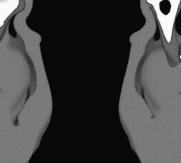 understanding-disc-osteophyte-complexes-at-c5-6-and-c6-7